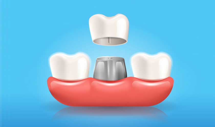 Featured image for “5 Instances When You Should Get Dental Crowns”