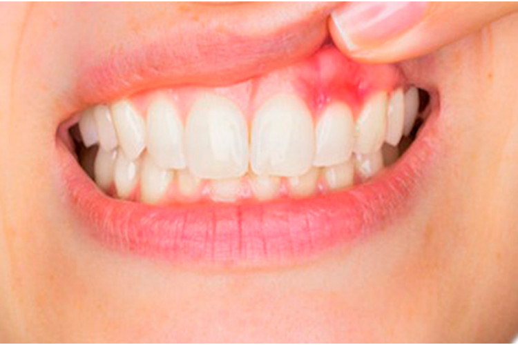 Featured image for “How Can You Protect Your Oral Health From Gum Disease?”