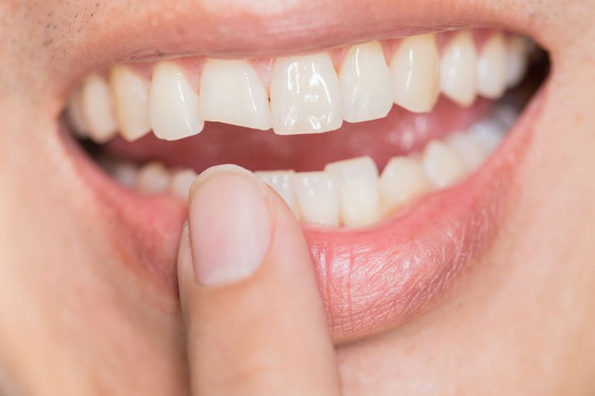 Featured image for “How Does Dental Bonding Helps In Restoring Your Pearly Whites?”