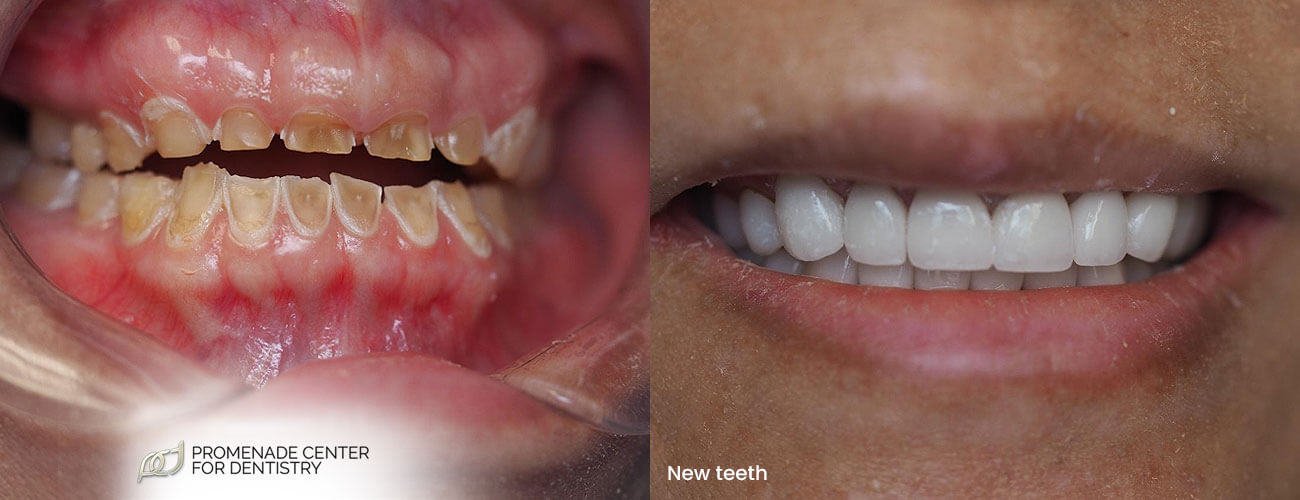 Featured image for “Getting New Teeth: A Dental Case Study”
