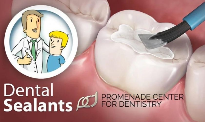 Featured image for “How Dental Sealants Prevent Your Teeth from Cavities?”