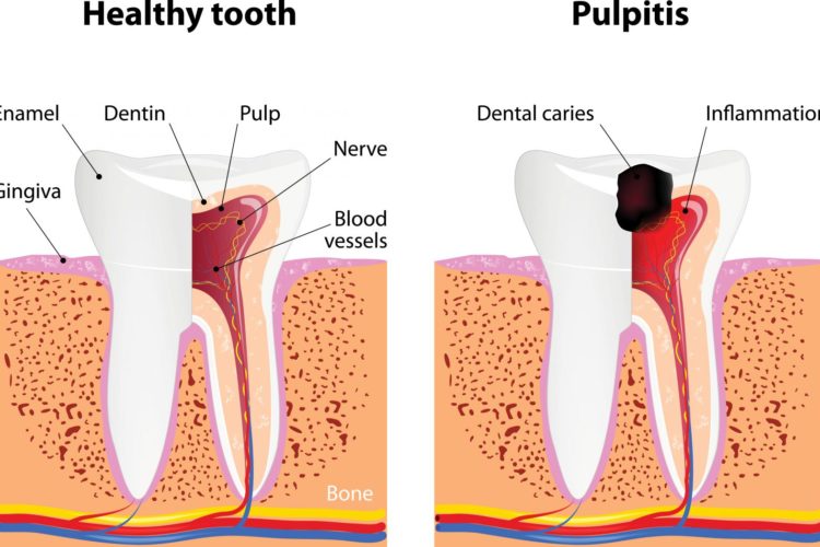Healthy tooth vs Pulpitis