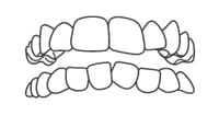 crooked-teeth