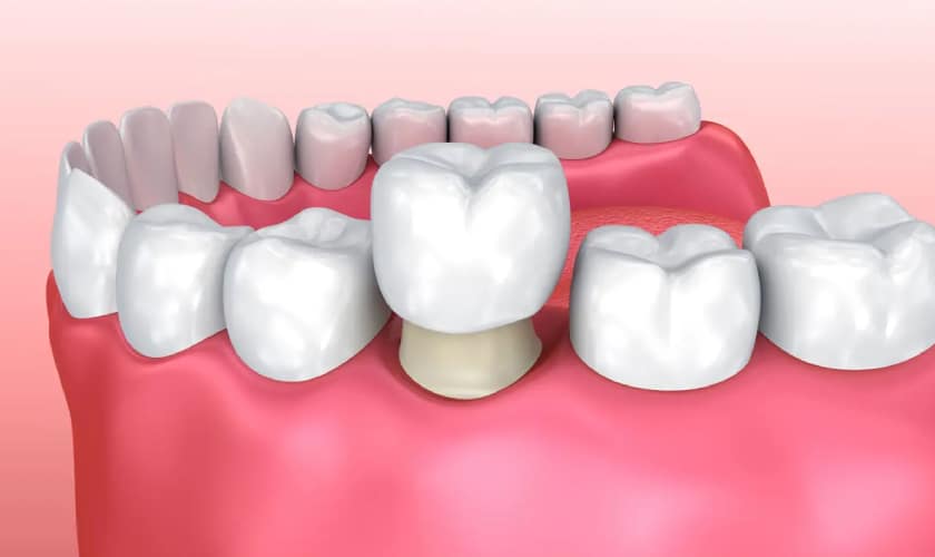 Featured image for “What are the benefits of dental crowns?”