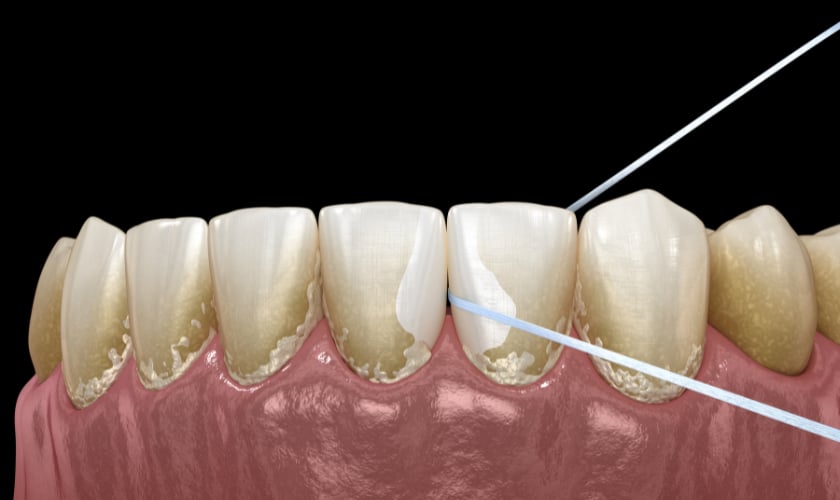 Removable dental veneers