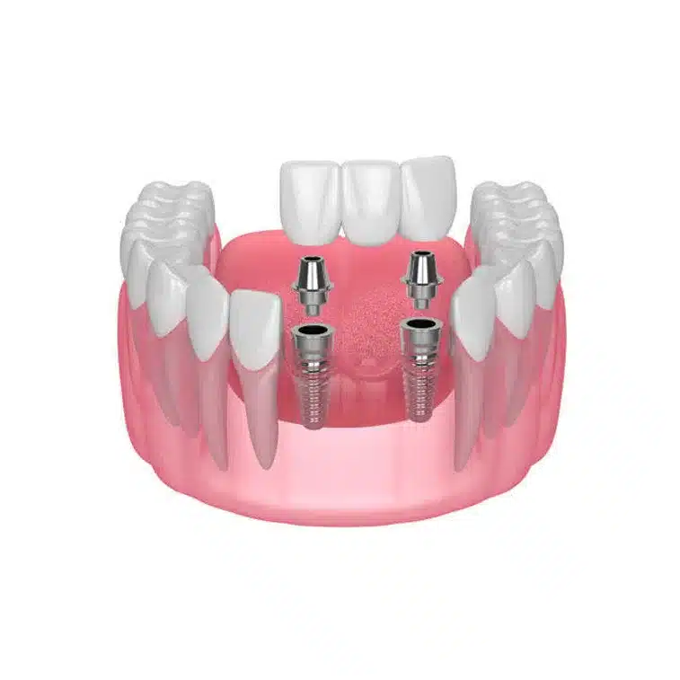 Implant Supported Bridge in Charlotte, Nc