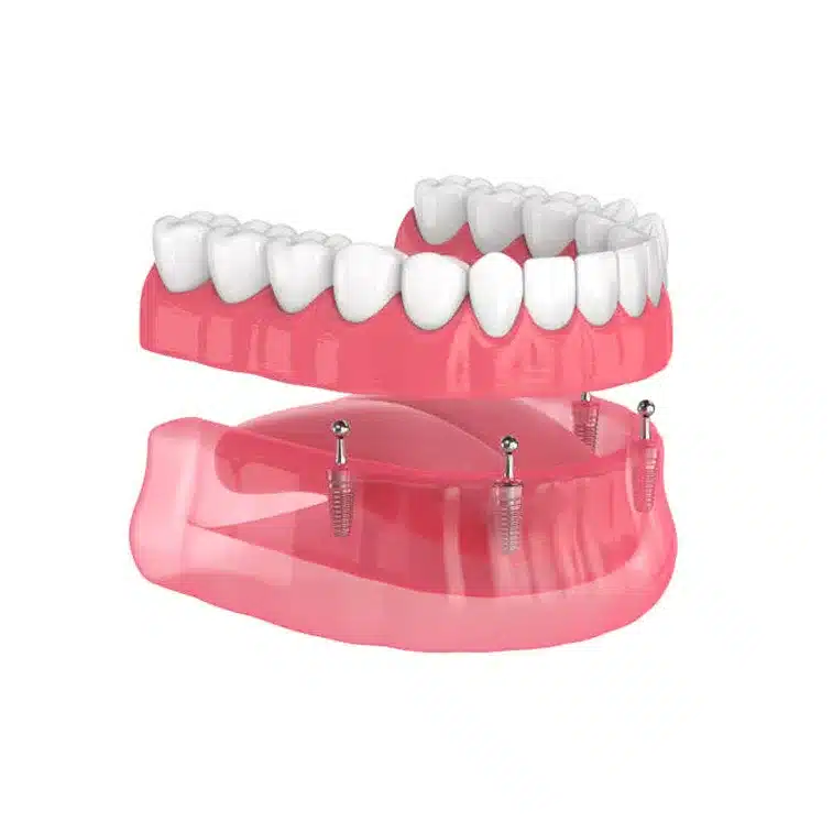 Implant supported overdenture in Charlotte NC