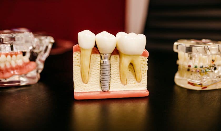 Featured image for “Dental Implant Procedures for Diabetic Patients”