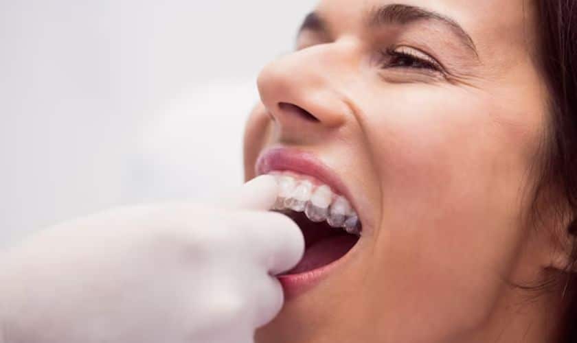 Teeth Straightening Charlotte - Adult Orthodontics - Invisalign Braces