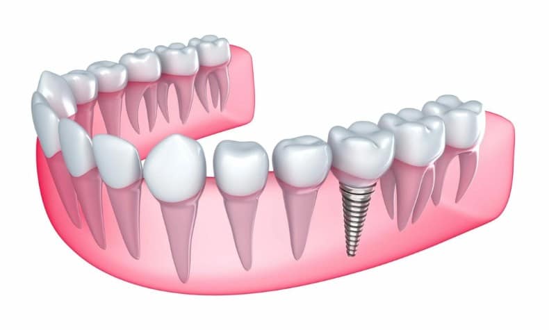 Featured image for “How Gums Grow and Bond to Dental Implant Teeth”