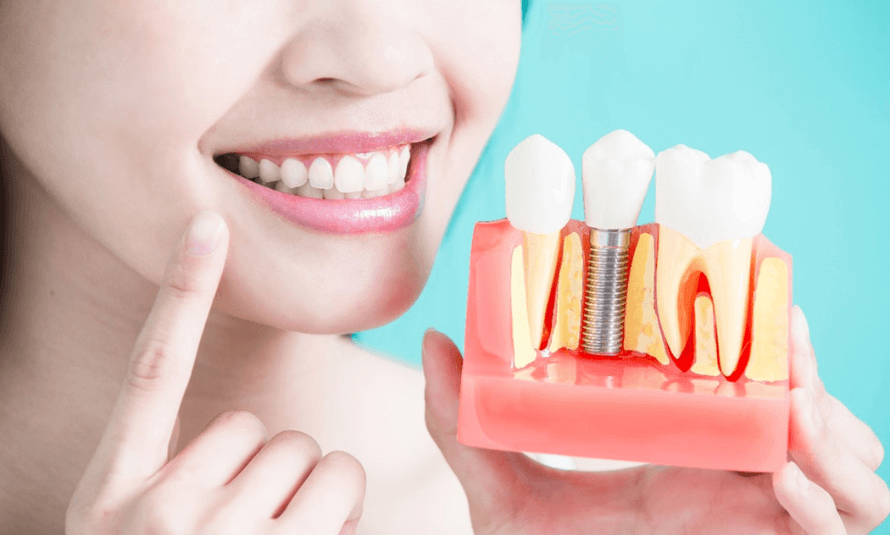 Featured image for “5 Ways Dental Implants Can Improve Your Smile”